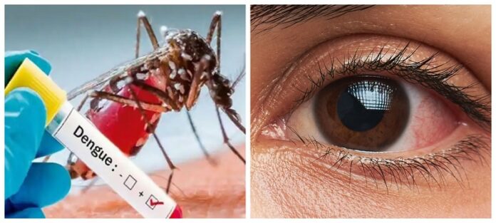 dengue-eye_yQuHwvJSp4